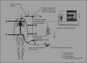Montaje del sistema PiCCO® Imagen reproducida con el permiso de Pulsion Medical Systems.