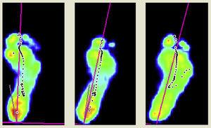 Different idiopathic toe walkers (ITW) models of step development: Type 1, 2 and 3 ITW.