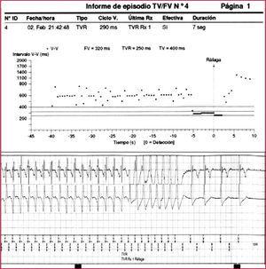 Ejemplo del resultado de la estimulación antitaquicardia (EAT) por sobreestimulación de una taquicardia ventricular rápida. En la parte superior de la figura se observa el gráfico de intervalos y en la parte inferior, el registro de los electrogramas (EGM) intracavitarios. FV: fibrilación ventricular; RX: terapia; TV: taquicardia ventricular; TVR: taquicardia ventricular rápida: V: ventricular.