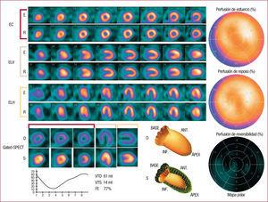 Presentación de los cortes tomográficos postesfuerzo (E) y de reposo (R) de una gated-SPECT de perfusión miocárdica normal. A la derecha se observan los mapas polares de esfuerzo, reposo y reversibilidad, divididos en 17 segmentos. En la parte inferior se exponen los datos de la gated-SPECT, con los cortes en diástole (D) y sístole (S), la curva de volumen y los valores obtenidos, junto con la imagen 3D del contorno endocárdico en diástole y sístole. EC: eje corto; ELH: eje largo horizontal; ELV: eje largo vertical; FE: fracción de eyección; VTD: volumen telediastólico; VTS: volumen telesistólico.