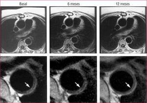 Imágenes transversales de resonancia magnética al mismo nivel de la aorta en un paciente tratado con estatinas. Obsérvese que tras 6 meses de tratamiento el volumen de la placa es muy similar, lo cual revela una detención de la progresión de ésta. A los 12 meses se aprecia una reducción del volumen de la placa. Tomado de Corti et al51.