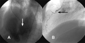Varón de 71 años que presenta infarto agudo de miocardio inferior complicado con insuficiencia cardiaca. A: imagen de ventriculografía en oblicua izquierda que muestra comunicación interventricular septomedial. B: oclusión aguda de la coronaria derecha proximal con imagen del muñón.