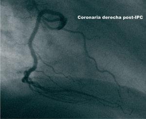 Aspecto de la lesión de la arteria coronaria derecha tratada tras la implantación del stent.