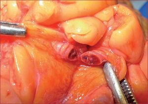 Trombosis aguda de arteria coronaria. Gentileza del Dr. Gabriel Font (Servicio de Patología Forense del Instituto Medicolegal de Cataluña)