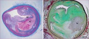 Lesiones similares a las humanas en el modelo de cerdo con hipercolesterolemia familiar (IHLC)40. A la izquierda, placa con núcleo necrótico (NC) y recubrimiento fibroso fino (FC); el colágeno se ve en azul (tricrómico de Masson). A la derecha, placa complicada que contiene colágeno (en verde, pentacrómico de Movat), calcificación, lípidos, inflamación y núcleo necrótico (NC).