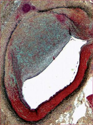 Placa en la arteria descendente anterior de un cerdo sometido a inyección de lípidos en la pared vascular 10 semanas antes. En esta tinción con el pentacrómico de Movat, se observa una placa fibrolipídica56.