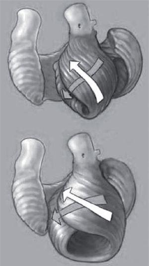 Ventricular shape. The changes between the normal elliptic left ventricle (above), containing an apex, and the dilated spheric heart (below) where apex is globally stretched, are compared to show differences in the underlying circumferential and helical loops that comprise ventricular architecture. Note the circumferential loop has transverse fibers similar in both shapes. The inner helical loop changes from a normal oblique configuration (shown by arrows at ~ 60° angulation) that enhances contractile force, to a more transverse configuration (shown by more horizontal arrows) as the dilated chamber stretches to cause fiber orientation changes that diminish contractile force.