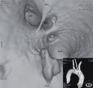 Dos imágenes de reconstrucción tridimensional de angio-TC. En pequeño, negativo del molde intraluminal que demuestra el defecto de repleción debido a la lesión tumoral dependiente de la pared aórtica en su ubicación opuesta a la salida del tronco braquiocefálico. En grande, endoscopia virtual del lumen aórtico a nivel del cayado con los ostium de salida de los troncos supraaórticos y la lesión tumoral en la curvatura menor. T: tumor; ASI: arteria subclavia izquierda; ACI: arteria carótida izquierda; TBCA: tronco braquiocefálico; AoA: aorta ascendente.