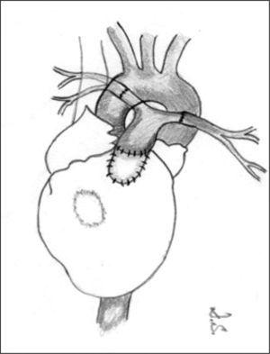 Colocación de un conducto desde el ventrículo derecho hasta las arterias pulmonares, que se han conectado entre sí. Se puede observar, asimismo, la comunicación interventricular que se cerrará o no dependiendo del tamaño resultante de las arterias pulmonares.