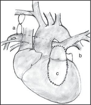 Cirugía correctora en paciente con ramas pulmonares confluentes y arterias colaterales aortopulmonares mayores. Se puede observar la fístula sistémica-pulmonar cerrada (a), las conexiones entre colaterales y las ramas pulmonares (b), y el conducto entre el ventrículo derecho y las ramas unifocalizadas (c).