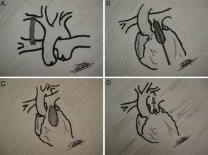 A) Fístula sistémico-pulmonar. B) Valvulotomía pulmonar percutánea. C) Parche transanular. D) Valvulotomía transpulmonar.