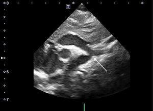 Imagen ecocardiográfica de una coartación aórtica en el recién nacido. En la zona de la flecha puede observarse la zona de estenosis aórtica inmediatamente después de la salida de la arteria subclavia izquierda.