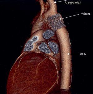 Reconstrucción de tomografía computarizada en paciente tras colocación de stent en la zona de coartación nativa. Ao D: aorta descendente; A. Subclavia I.: arteria subclavia izquierda.
