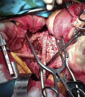 Arteria femoral común izquierda.