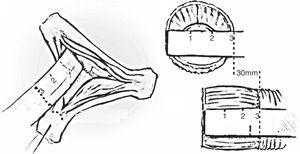 Medida del tamaño de la prótesis basada en el método de la medición de la altura de la comisura del velo izquierdo-no coronario. Método propuesto por El Khoury10. La distancia desde el anillo mitral hasta el vértice de la comisural corresponde al diámetro del injerto vascular.