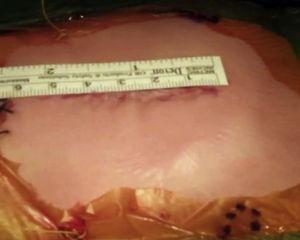 Longitud final de la incisión en un lactante. Véase cómo la incisión tiene una longitud de aproximadamente 5 cm.