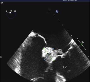 Imagen ecocardiográfica en la que se observan el absceso, la vegetación insertada en el anillo mitral con visión del velo anterior de la válvula mitral y ventrículo izquierdo.