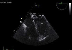 Imagen ecocardiográfica del alta donde se ven la reducción y la cavitación parcial del absceso, la desaparición de la vegetación, el velo anterior de mitral y el ventrículo izquierdo.