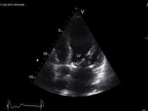 Imagen ecocardiográfica un año después de la cirugía con fibrosis y desaparición del absceso.