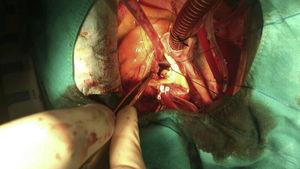 Aortotomía transversa. Desinserción del velo coronario derecho.