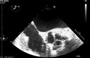 Imagen ecocardiografica con corte transversal de la prótesis en diástole.