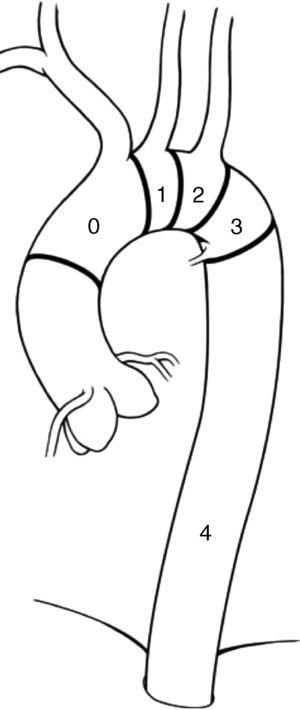 Anatomía endovascular del arco aórtico. Zona 0: aorta ascendente y salida del tronco braquiocefálico; zona 1: salida de la arteria carótida izquierda; zona 2: salida de la subclavia izquierda, y zona 3: aorta descendente proximal).