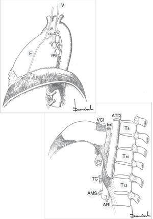 Visión de tórax izquierdo e hiatos diafragmáticos. AMS: arteria mesentérica superior; ARI: arteria renal izquierda; ATD: aorta torácica descendente; Es: esófago; F: nervio frénico; LA: ligamento arterioso; LR: nervio laríngeo recurrente; T: cuerpo vertebral torácico; TC: tronco celíaco; V: nervio vago; VCI: vena cava inferior; VPII: vena pulmonar inferior izquierda.
