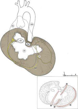 Frenotomías preservadoras del nervio frénico. ATD: aorta torácica descendente; CF: centro frénico; Es: esófago; F: nervio frénico; PE: pericardio; REF: rama esternal frénica; VCI: vena cava inferior; 1: frenotomía circunferencial; 2+2′: frenotomía radial parcial; 3: frenotomía línea media.