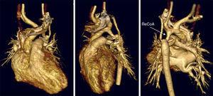 Reconstrucción tridimensional de tomografía computarizada cardíaca anterior, lateral izquierda y posterior (respectivamente, de izquierda a derecha) de lactante de 3 meses con recoartación y 2 toracotomías previas neonatales. (Cortesía de la Dra. M. Bret).ReCoA: recoartación.