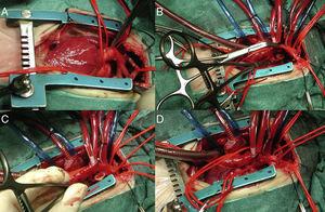 Imágenes intraoperatorias de neonato con D-transposición de grandes arterias+comunicación interventricular+interrupción de arco aórtico tipo A, operado por esternotomía. Vista del arco tras la apertura del pericardio (A). Cánula arterial en tronco braquiocefálico y cánulas venosas en ambas cavas, pinzadas la aorta ascendente y la descendente con el tejido ductal resecado (B). Anastomosis latero-terminal (avance aórtico) observándose las bocas anastomóticas (C) y anastomosis completa habiendo retirado la pinza distal (D).