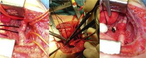 Imágenes intraoperatorias: lactante de 2 meses con coartación de aorta aislada operada por toracotomía. Disección del itsmo aórtico, aorta descendente y ligamento ductal (A). Aorta pinzada proximal y distal, resecada la coartación, y realizada la parte posterior de la anastomosis (B). Anastomosis término-terminal completa y despinzada la aorta, muñón del ligamento ductal con ligadura de seda (C).