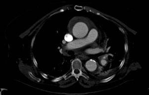 Imagen de TAC torácica que muestra la presencia de un hematoma intramural en aorta ascendente.