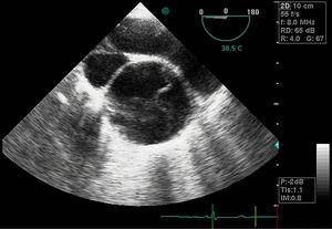 Imagen de ecocardiograma transesofágico en la que se observa el flap de la disección aórtica.
