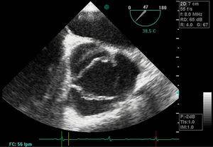 Imagen de ecocardiograma transesofágico en la que se observa el flap de la disección aórtica en el seno no coronario así como los velos de la válvula aórtica.