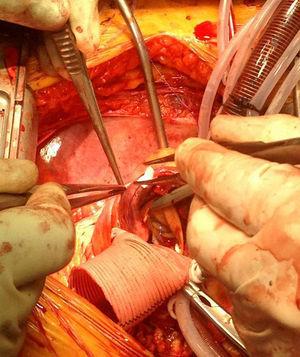 Imagen del tratamiento quirúrgico del hematoma intramural en aorta ascendente mediante la sustitución por tubo protésico.