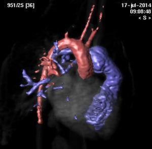 Resonancia magnética en la que se aprecia rama aortopulmonar con origen en aorta descendente dirigiéndose hacia lóbulo pulmonar inferior derecho.