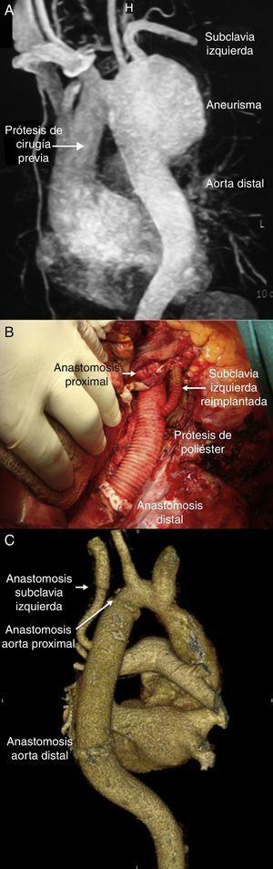 Modelo aorto-aórtico con reimplante de la arteria subclavia izquierda con interposición de tubo de PTRC realizado en 2 pacientes. A) ATC preoperatoria. B) Resultado final intraoperatorio. C) ATC postoperatoria.