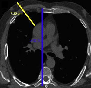TC sin contraste, corte axial a nivel de bifurcación pulmonar. Se aprecia que más de un 50% de la aorta sobrepasa el borde esternal derecho (línea azul) y una distancia aorta-pared torácica de 7,25 cm (línea amarilla), lo que cumple criterios para MTA.