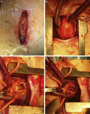 Imágenes operatorias de una HES por 3.er EICD. A)Incisión de 8 cm y apertura en J. B)Canulación en aorta ascendente y cava superior. C)Imagen operatoria tras escisión valvular. D)Visión del cirujano tras el implante valvular.