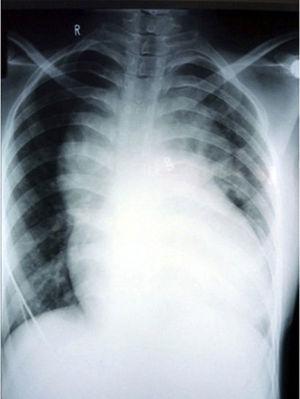 Radiografía de tórax: silueta cardiaca en forma de “muñeco de nieve” característico del DATVP.
