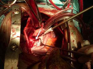 Imagen quirúrgica: apertura de aurícula izquierda. Flecha: colector pulmonar en cara posterior de aurícula izquierda.