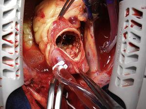 Se realizó una aortotomía oblicua, para permitir el acceso a la prótesis CoreValve®. Se observa el marco de nitinol de la prótesis CoreValve® parcialmente endotelizado a nivel de la unión sinotubular y aorta ascendente.