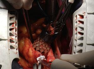 Momento de la explantación de la válvula CoreValve®, parcialmente colapsada, con apoyo de un torniquete en el extremo distal del marco, y un medidor de válvula mecánica N.° 21 marca St. Jude®.