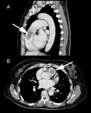 Tomografía axial computarizada con contraste. A. Corte sagital. B. Corte transversal. Se aprecia tumoración que ocupa el tracto de salida del ventrículo derecho (flechas).
