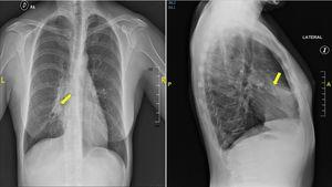 Radiografía de tórax que muestra objeto metálico intrapulmonar en forma de aguja con neumonía distal asociada.