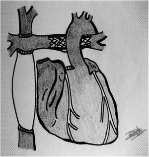 Esquema de Fontan. Conexión cava superior con arteria pulmonar derecha (Glenn), conducto entre cava inferior y arteria pulmonar derecha (Fontan extracardiaco). Detalle del stent en rama pulmonar izquierda.