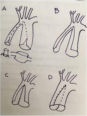 Reconstrucción de neoaorta tras procedimiento híbrido. Retirada de stent ductal y apertura lateral de aorta y pulmonar. Sutura posterior y anterior para conformar un vaso único (técnica «falda-pantalón»).