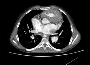 Imagen de tomografía computarizada en la que se observan unas venas pulmonares izquierdas que drenan a la aurícula izquierda, mientras que las derechas lo hacen a la aurícula derecha.