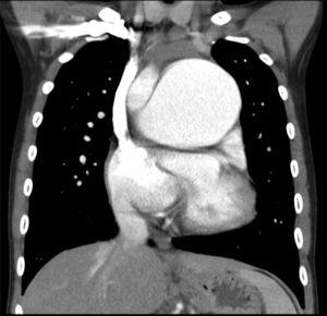 Imagen de tomografía computarizada en la que se observa gran dilatación aneurismática de la arteria pulmonar que comprime y desplaza estructuras adyacentes.