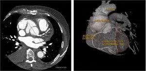 Imágenes obtenidas mediante angio-TC. De izquierda a derecha: corte axial y reconstrucción en 3D de comunicación entre pseudoaneurisma de aorta ascendente y aurícula derecha (AD).